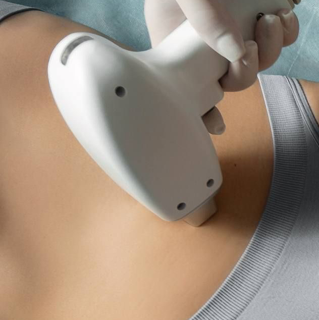 Лазерная эпиляция Живот полностью