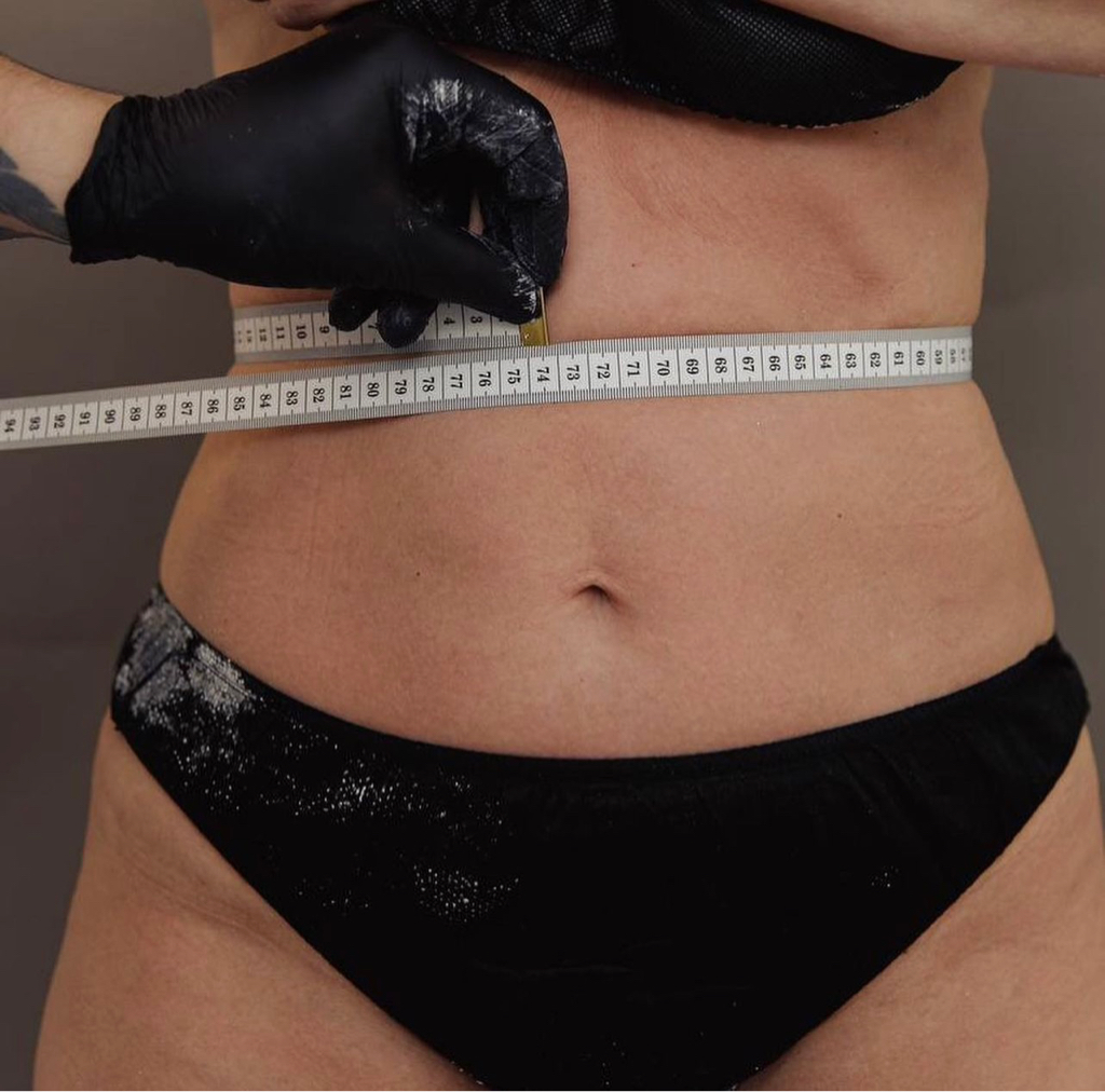 Гипсовое обертывание