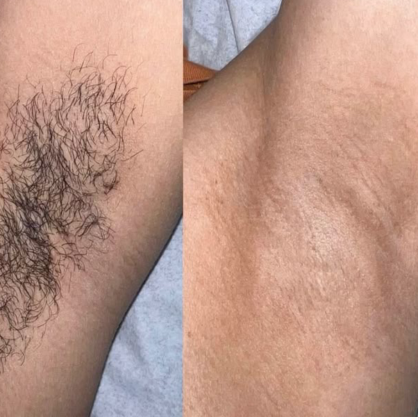 Лазерная эпиляция Подмышки мужские