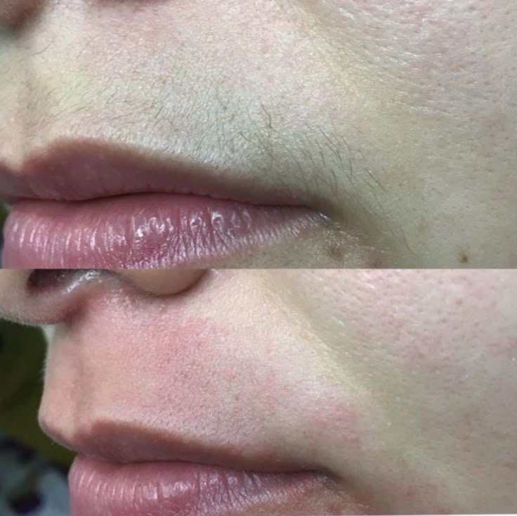 Лазерная эпиляция Верхняя губа