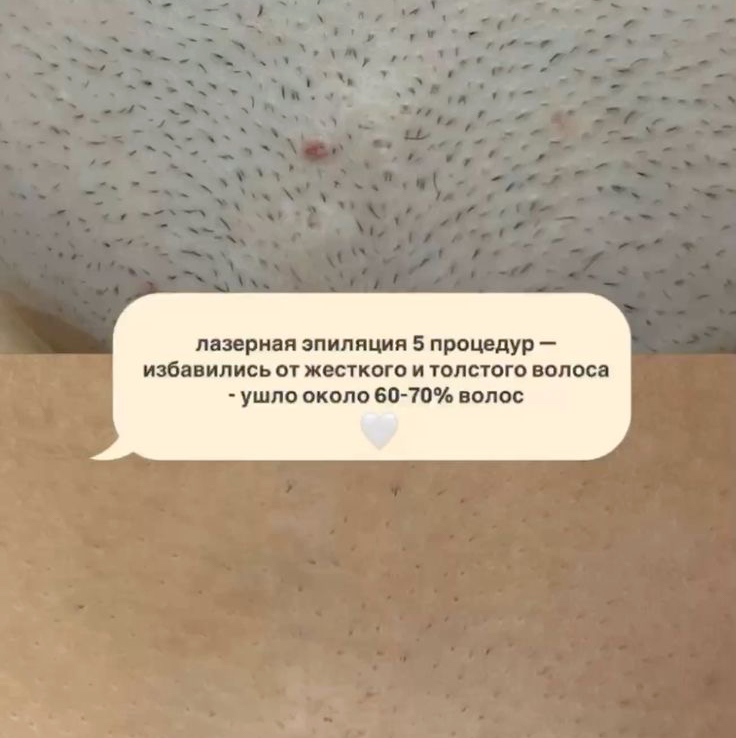 Лазерная эпиляция Бикини глубокое