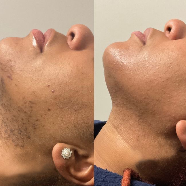 Лазерная эпиляция Подбородок