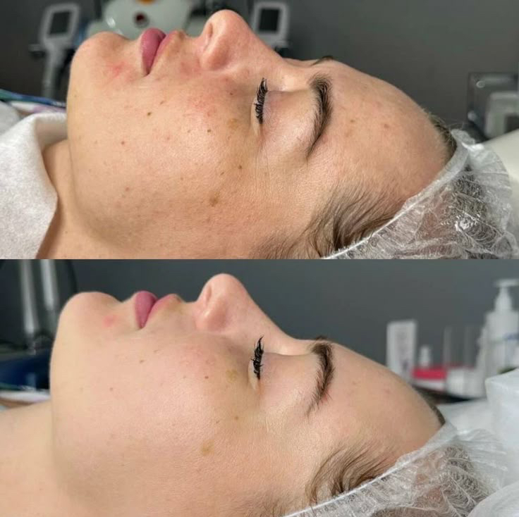 Пилинг Джесснера