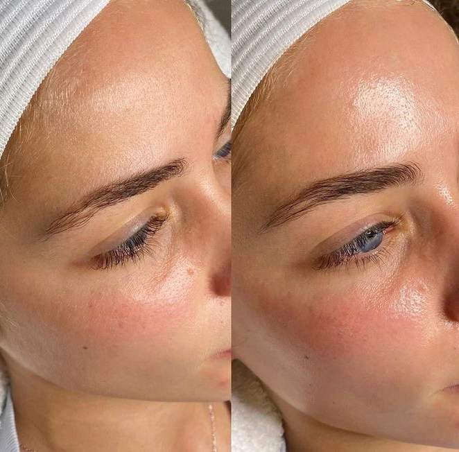 Пилинг Молочный