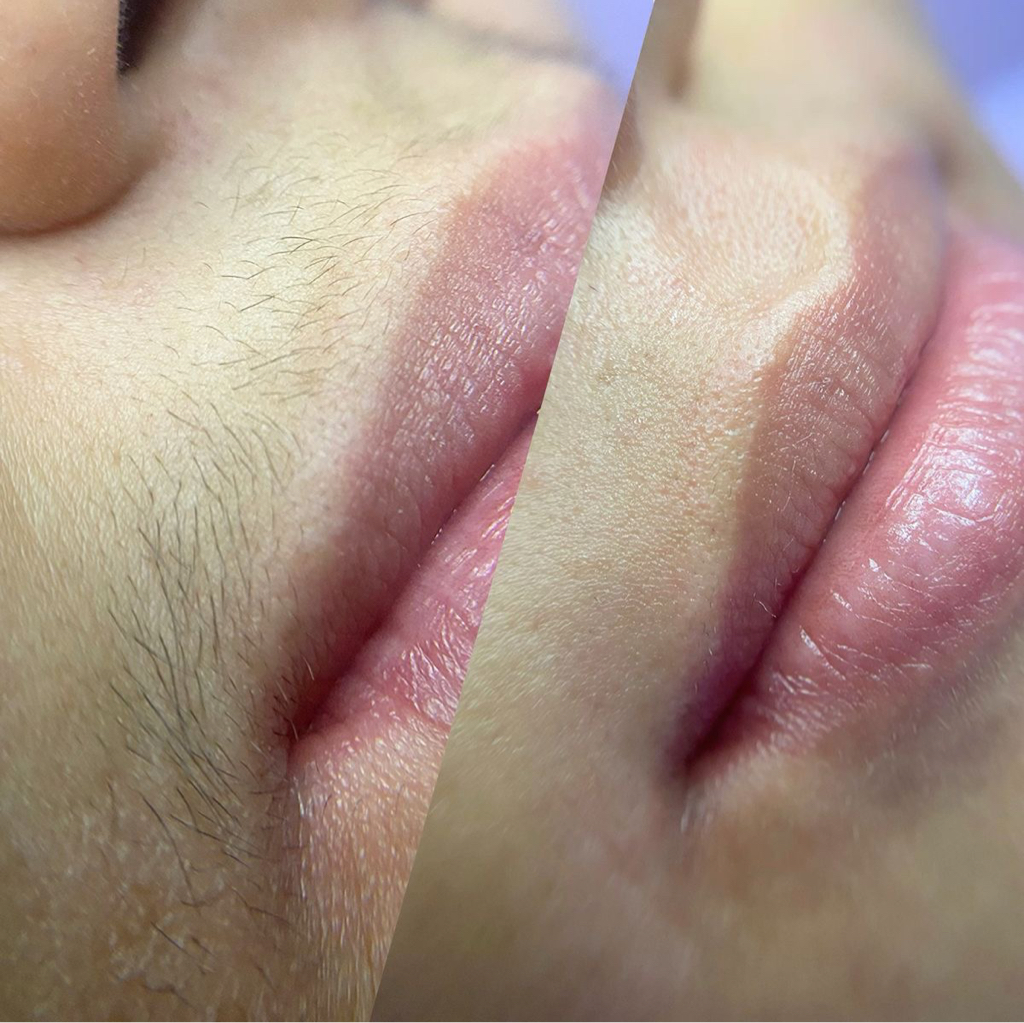 Депиляция воском волосков над губой