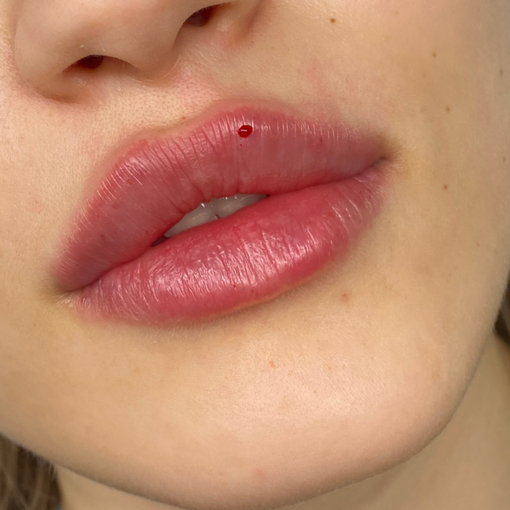 Увеличение губ