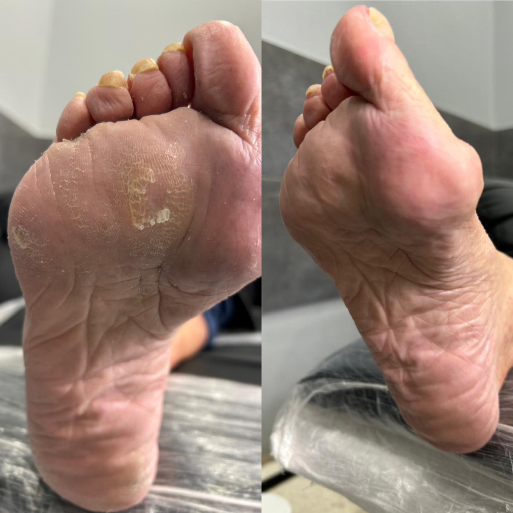 PEDICURE SMART сложные стопы (трещины, натоптыши) с обработкой пальчиков