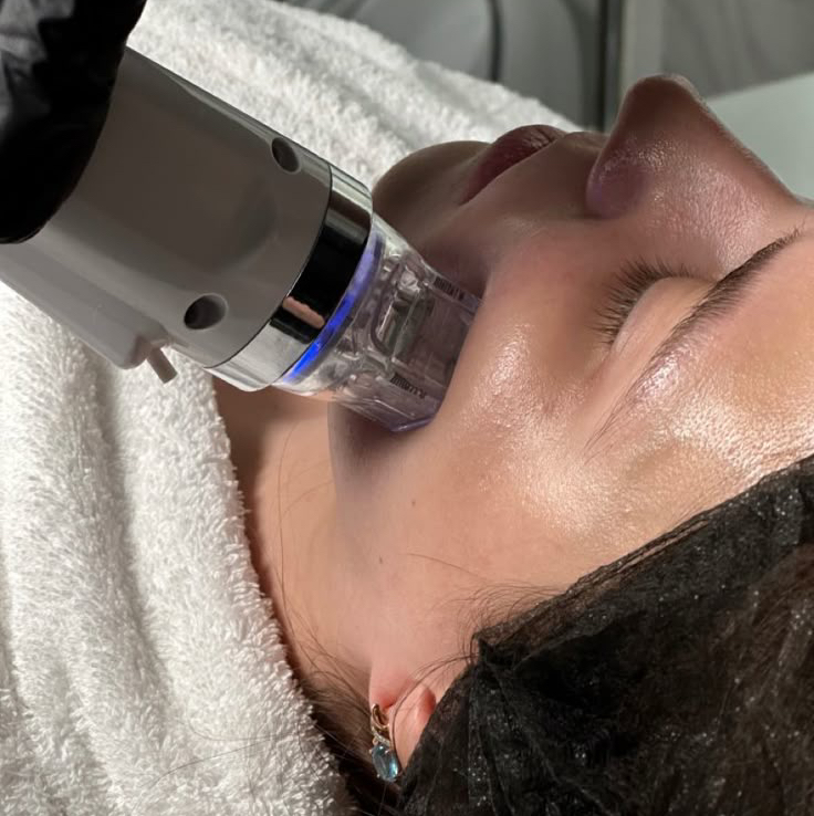 Микроигольчатый Rf-лифтинг уходовый : Лицо+Шея+декольте.Перодичность раз в 5 недель (3-4 раза).