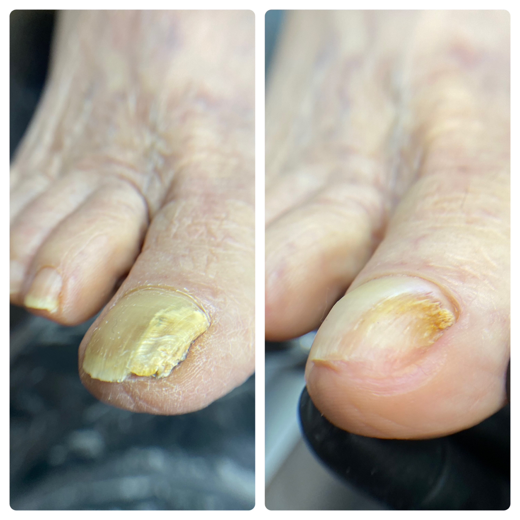 Подологический педикюр 3 степени