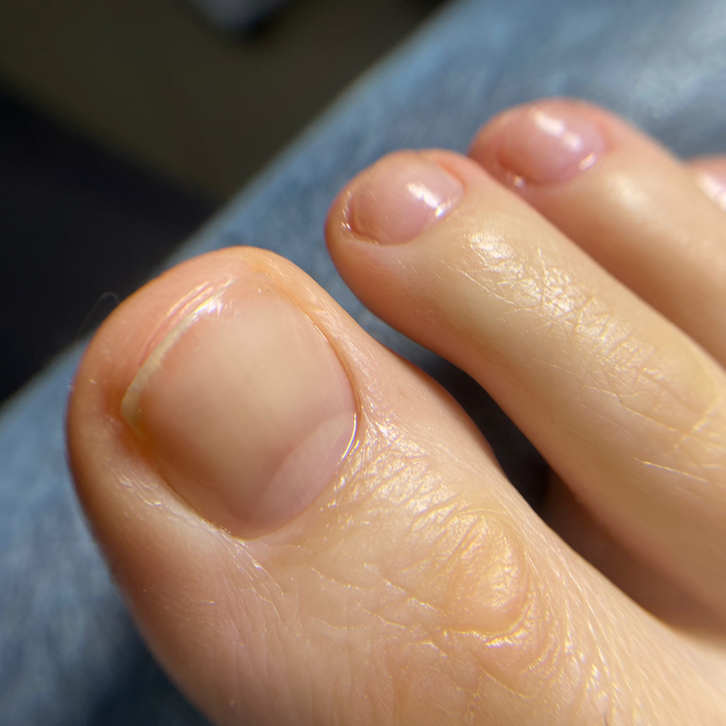 Подологический педикюр 1 степени