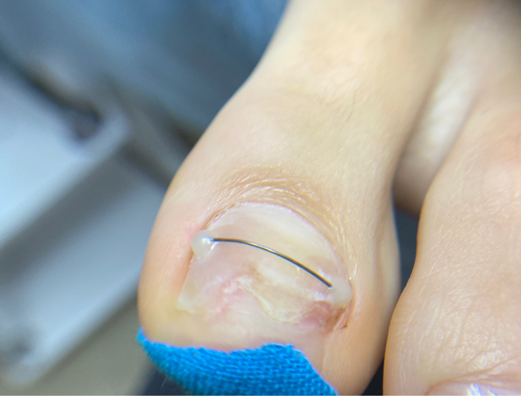 Установка титановой нити