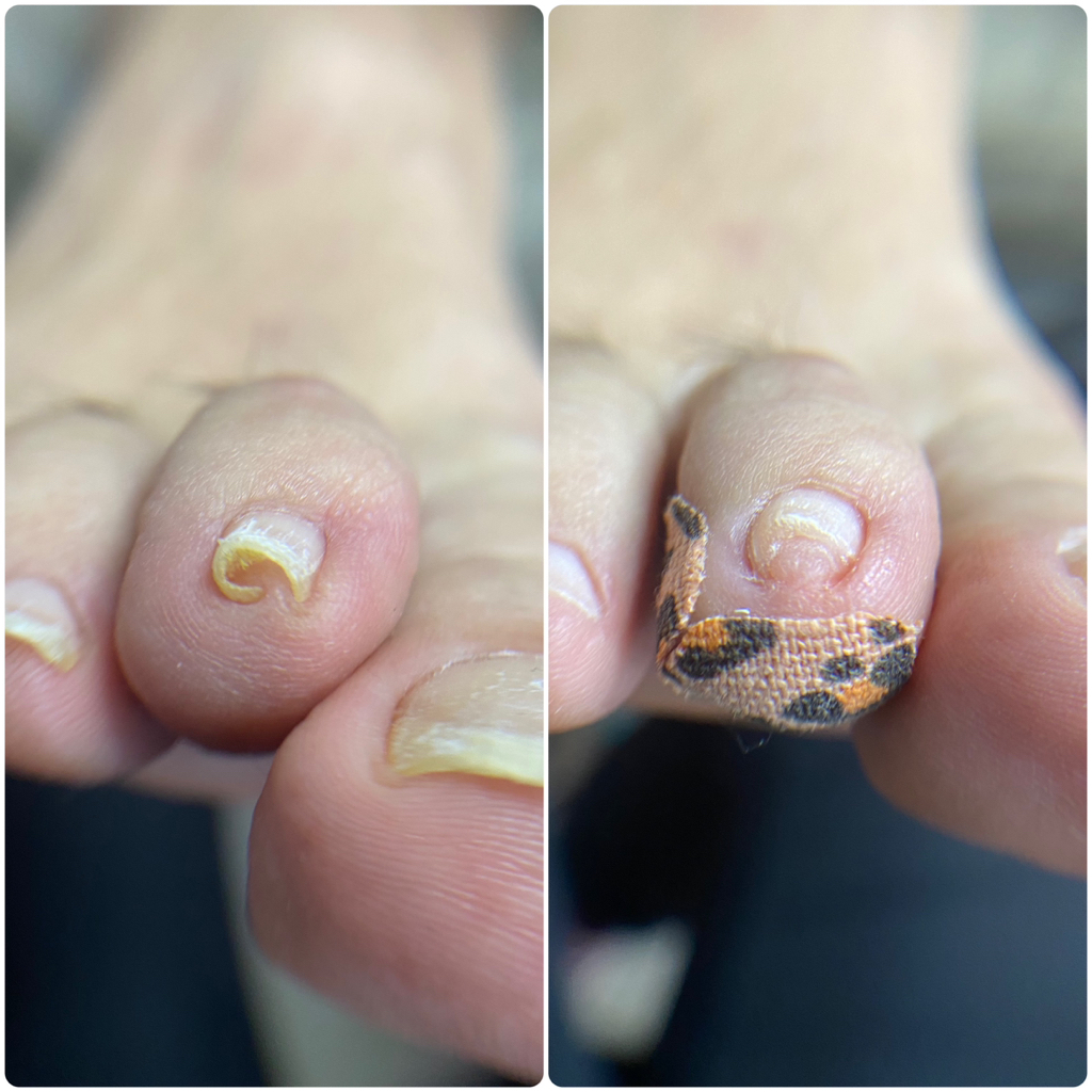 Подологический педикюр 2 степени