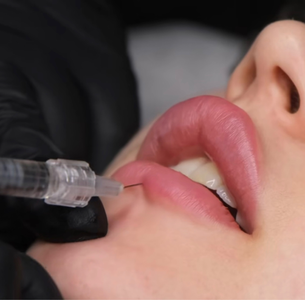 Контурная пластика губ