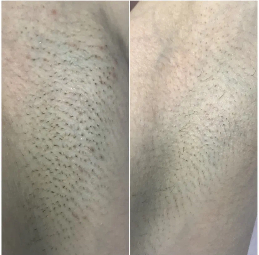 Ноги полностью + глубокое бикини + подмышки + руки полностью