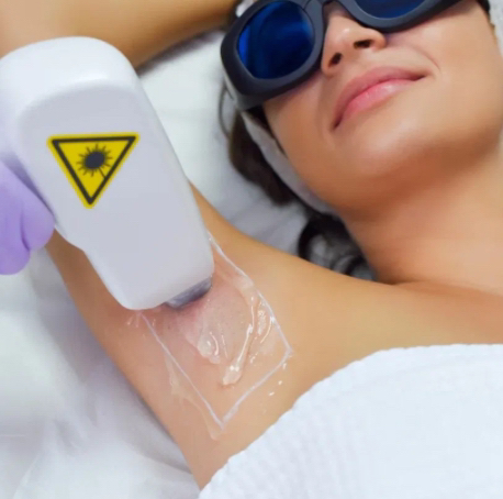 Лазерная эпиляция: подмышки