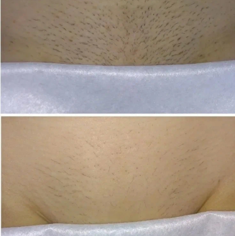 Лазерная эпиляция классическое бикини