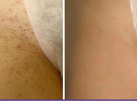 Ноги голень + глубокое бикини