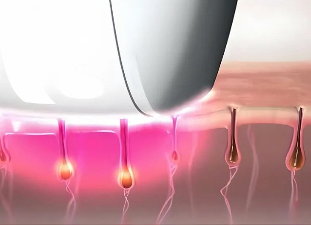Подготовка к лазерной эпиляции