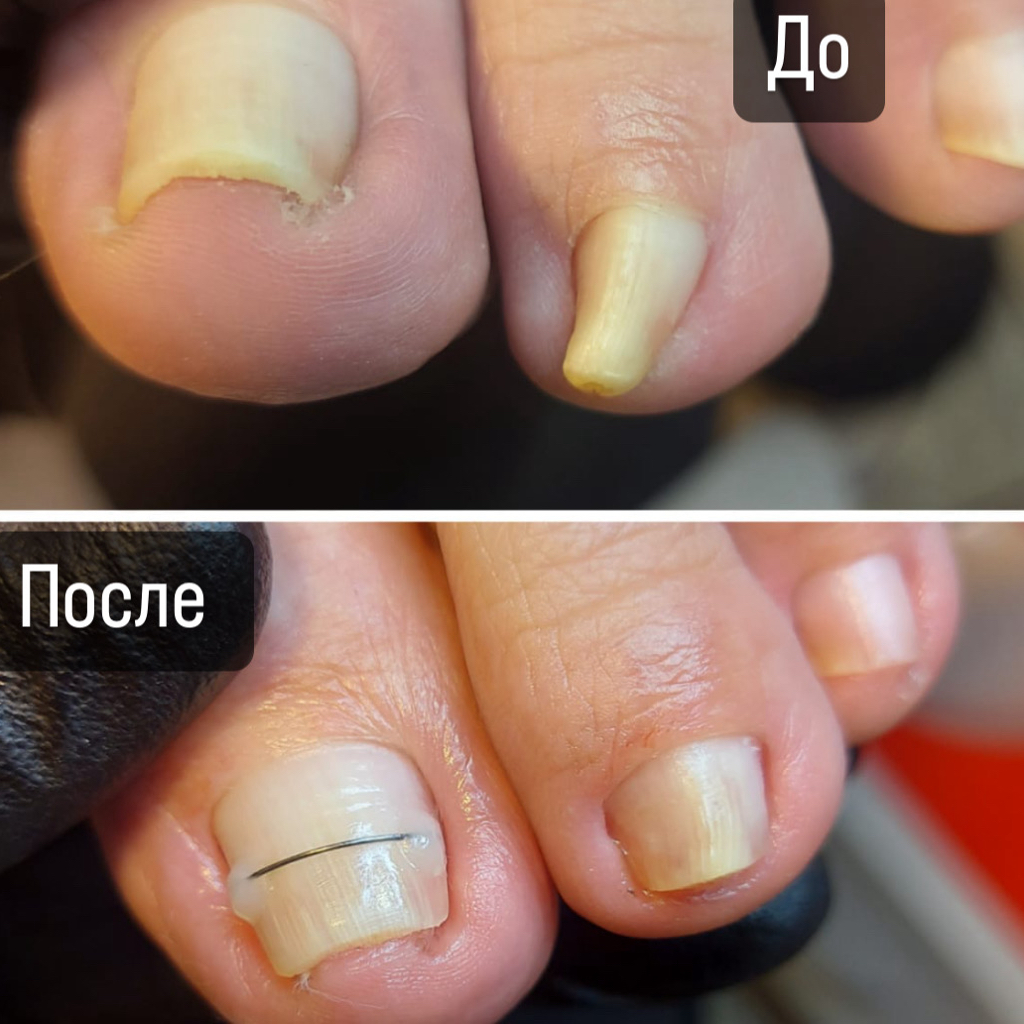 Установка системы Титановая нить при врастающем/скрученном/травмированном ногте