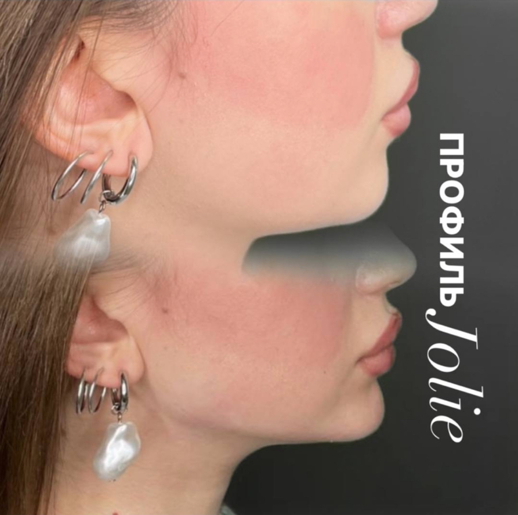 Углы нижней челюсти 2мл