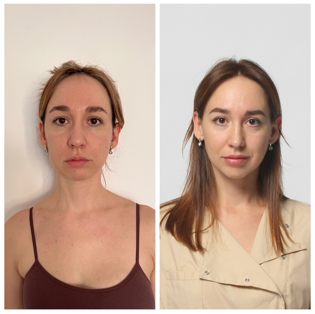 Фейспластика