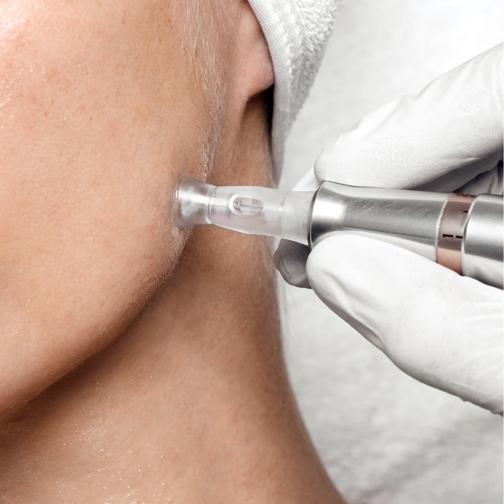 Мезотерапия микронидлинг (DermaPen)