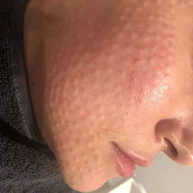 Мезотерапия лица