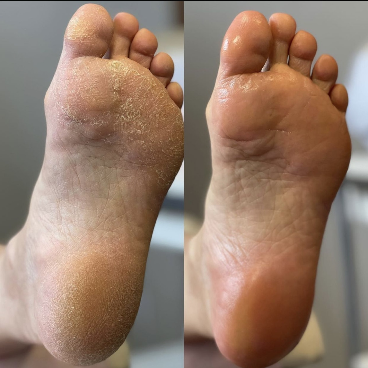 Обработка стоп «СТАНДАРТ» SMART дисками