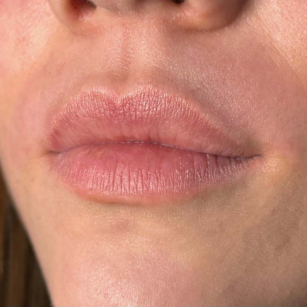 Удаление нежелательных волос на лице (1 зона)