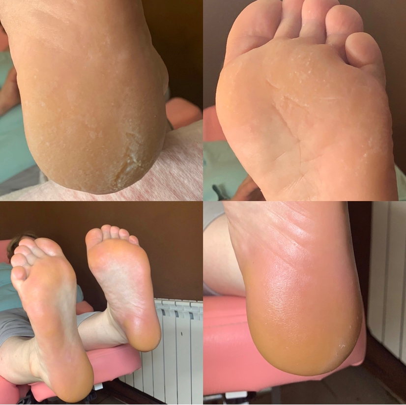 Педикюр Аппаратный