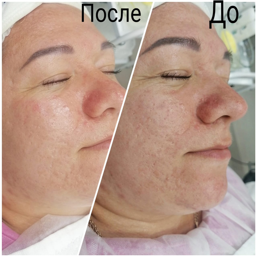 Чистка лица