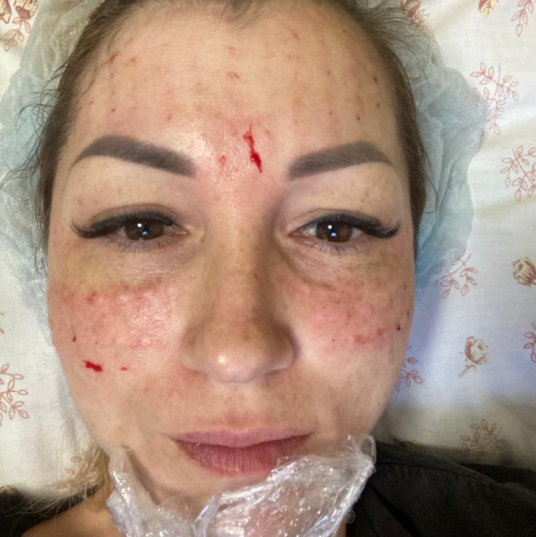 Мезотерапия