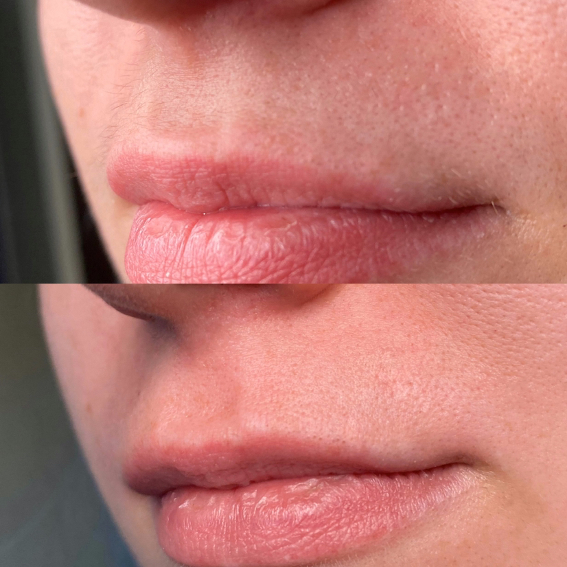 Депиляция одной зоны на лице