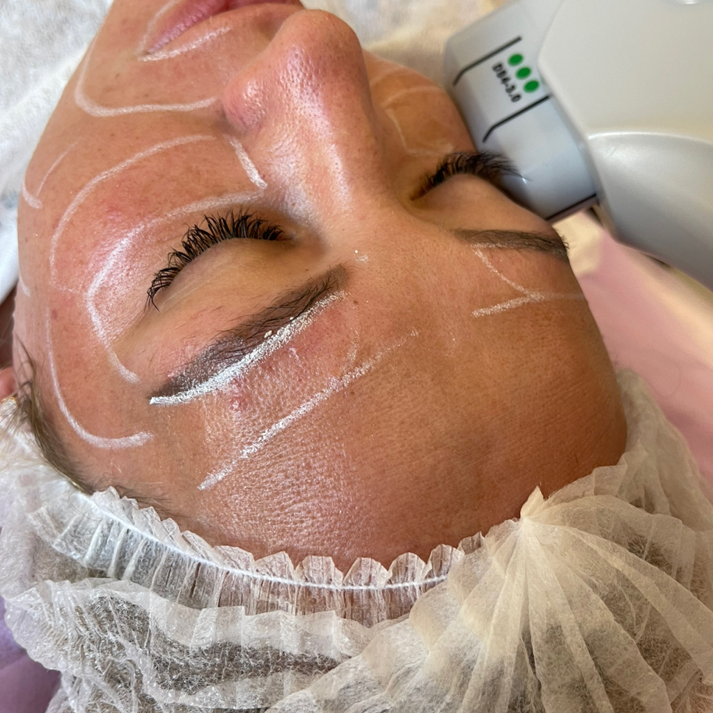 Аппаратный SMAS ЛИФТИНГ Полностью лицо (лоб+средняя часть лица +нижняя+вокруг глаз.