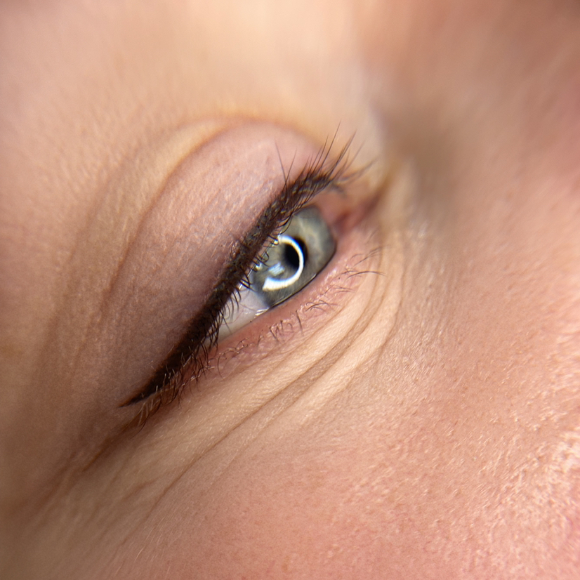 Межресничка