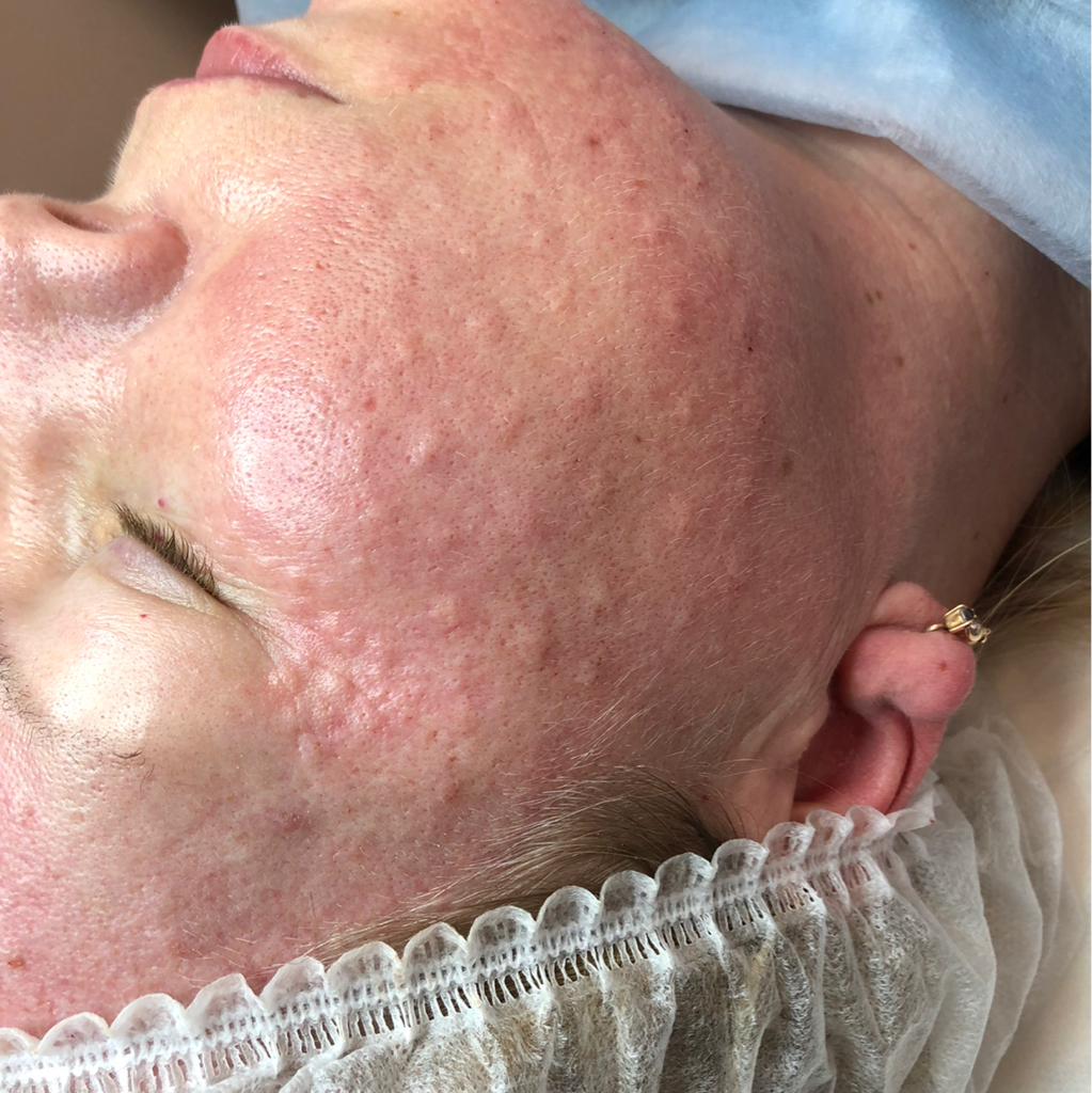 Биоревитализация Novacutan Sbio/Ybio