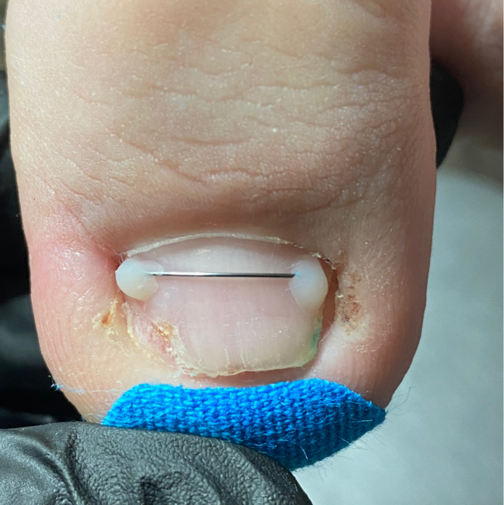 первичная установка титановой нити