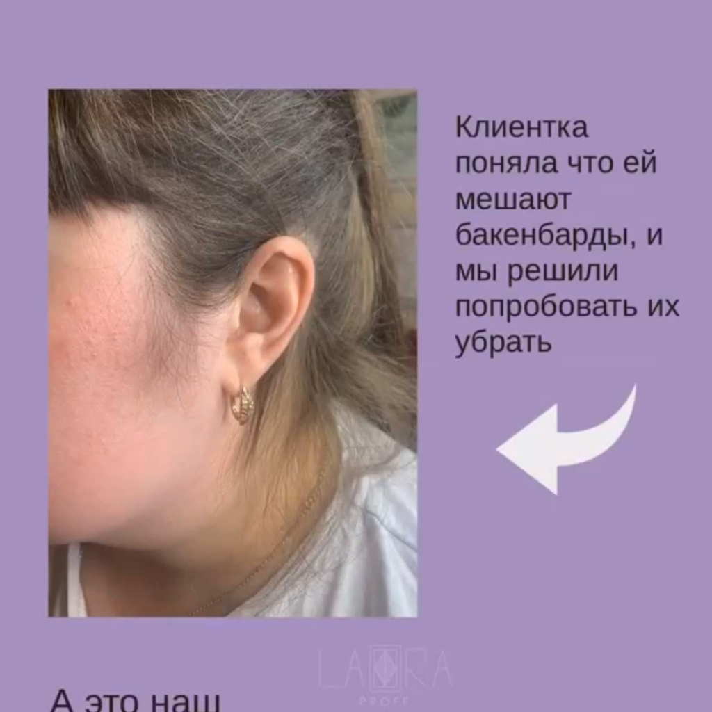 Депиляция лицо полностью