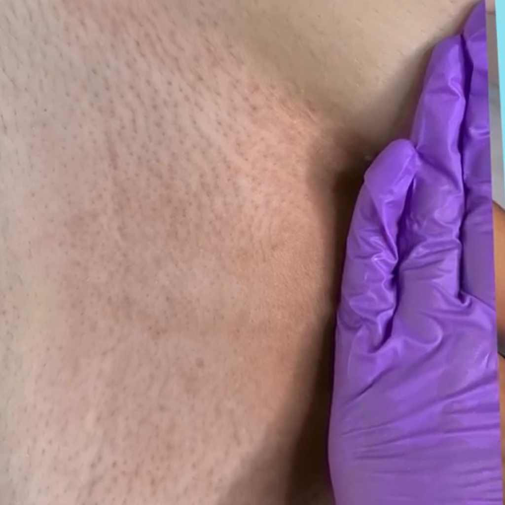 Шугаринг глубокое бикини