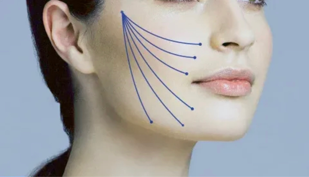 НИЖНИЕ 2/3 ЛИЦА Подтяжка и уменьшение глубины складок (1 зона) 
Эффект ориентировочно 18 мес