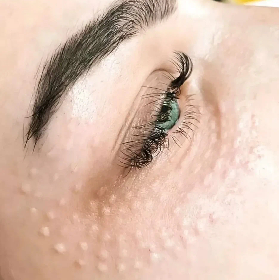 Мезотерапия(глаза)