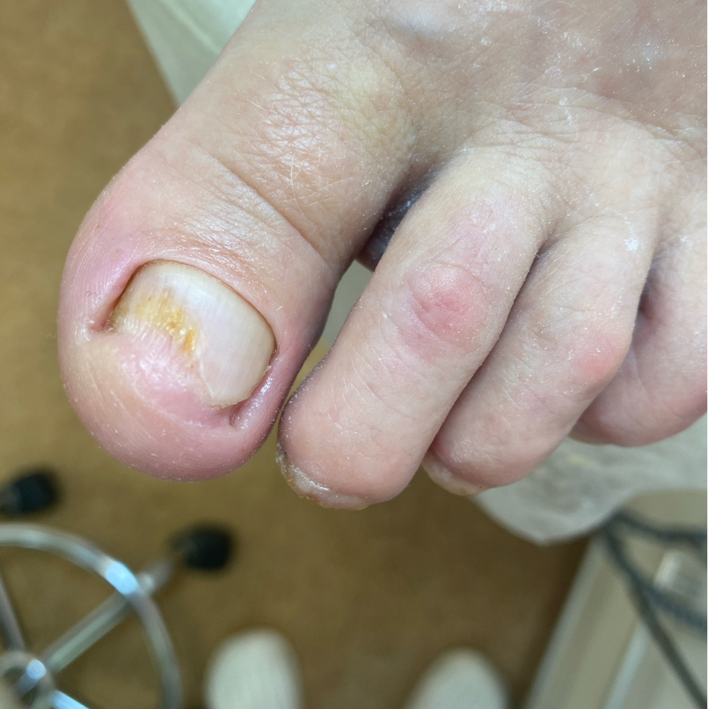 Зачистка грибкового поражения (только ногти) сложные