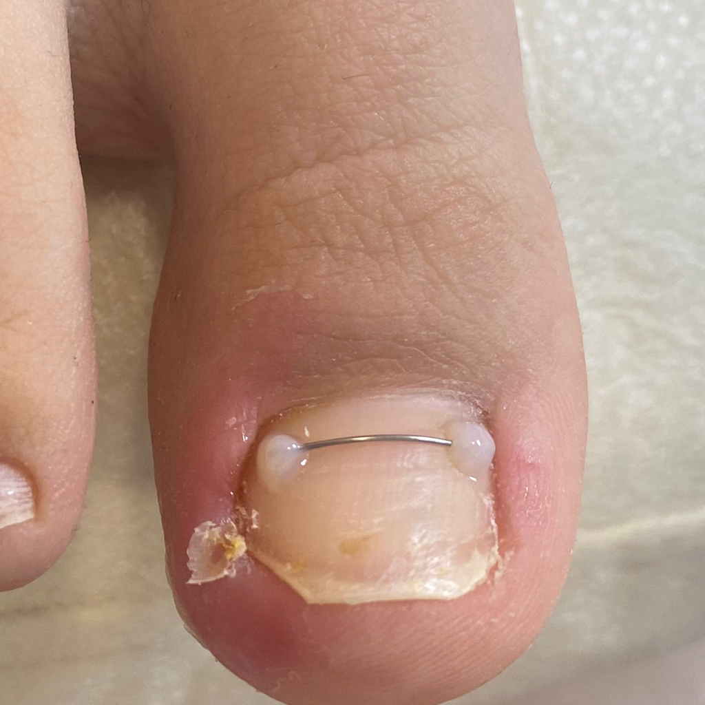 Титановая нить (скоба от вросшего ногтя)