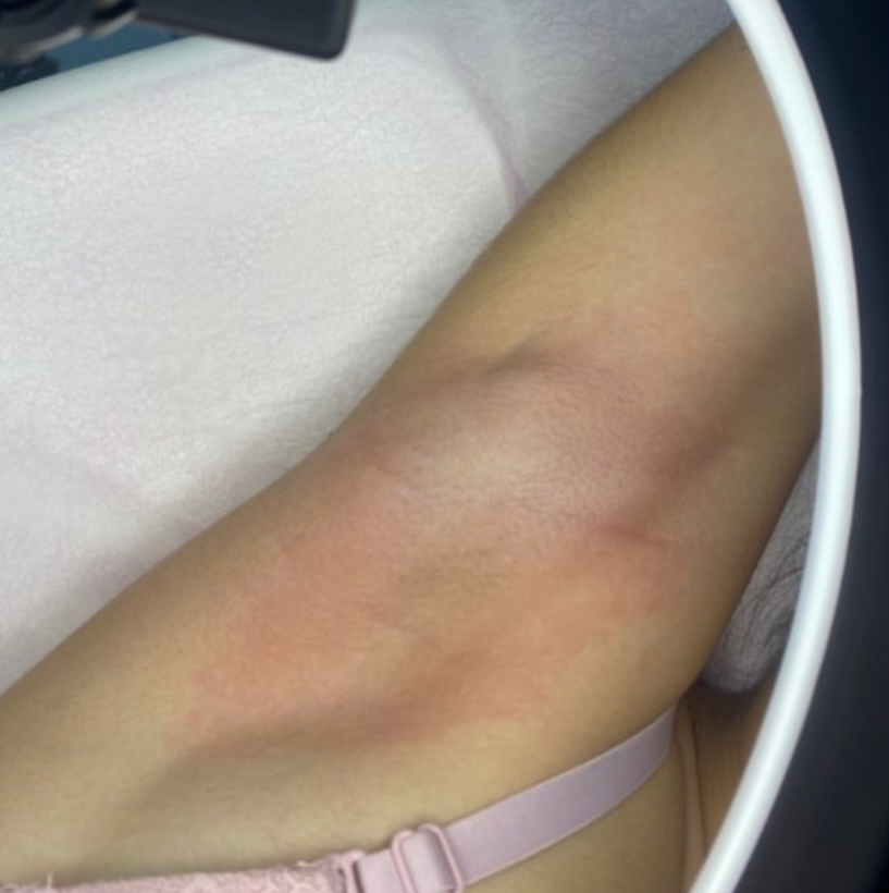 Депиляция подмышек