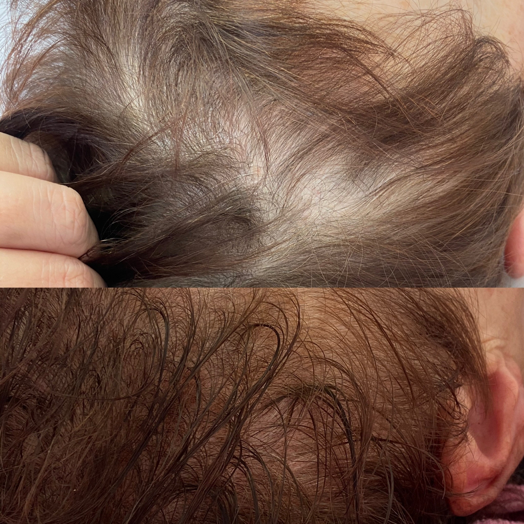 Трихопигментация головы