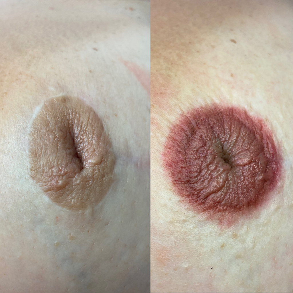 Камуфляж послеоперационный ( ореолы )