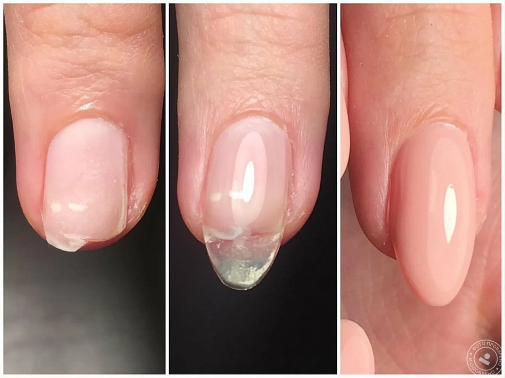 Коррекция 1 ногтя