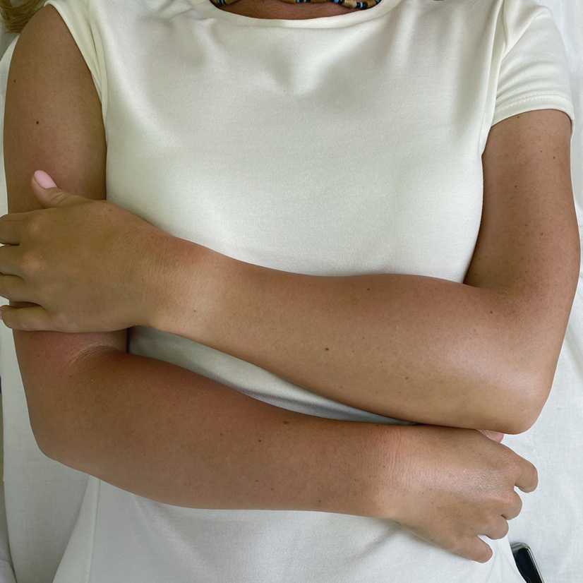 Депиляция рук полностью