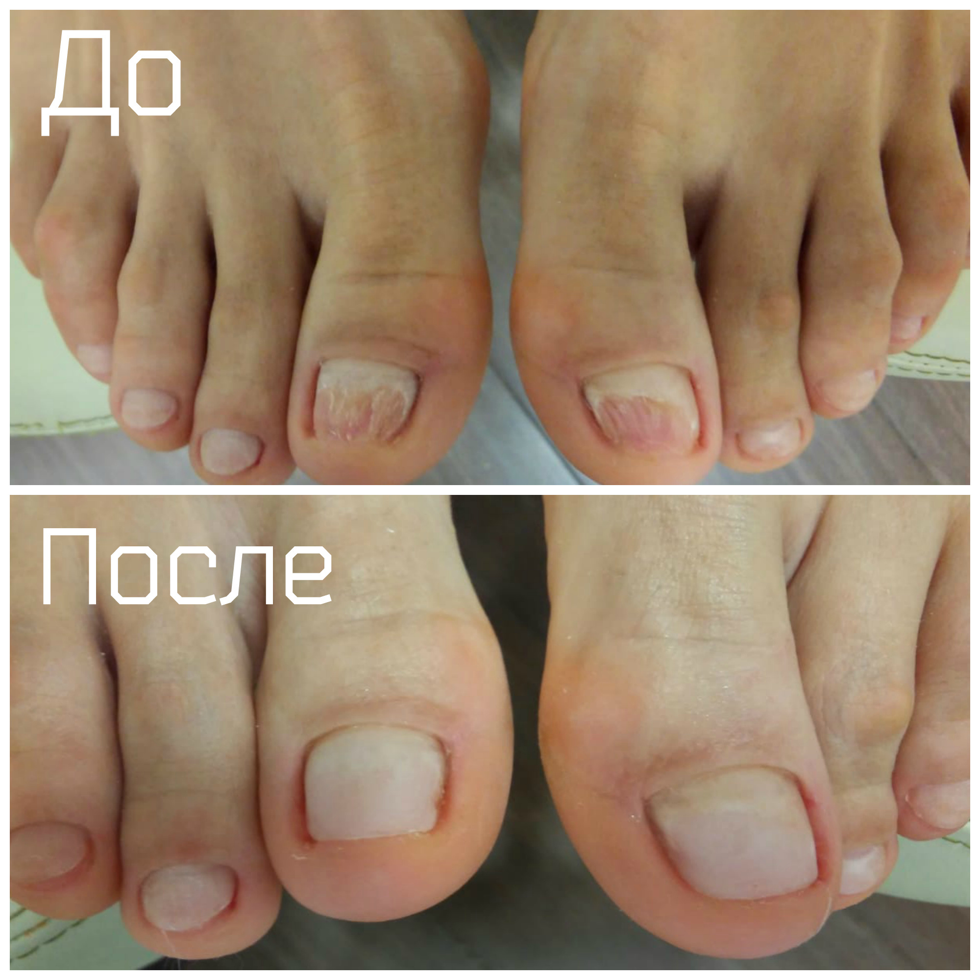 протезирование ногтя