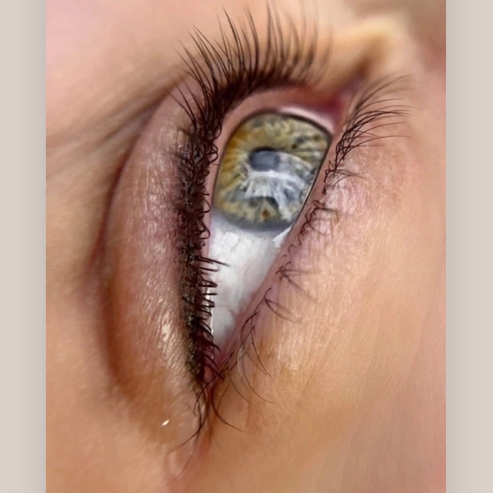 пм межресничка